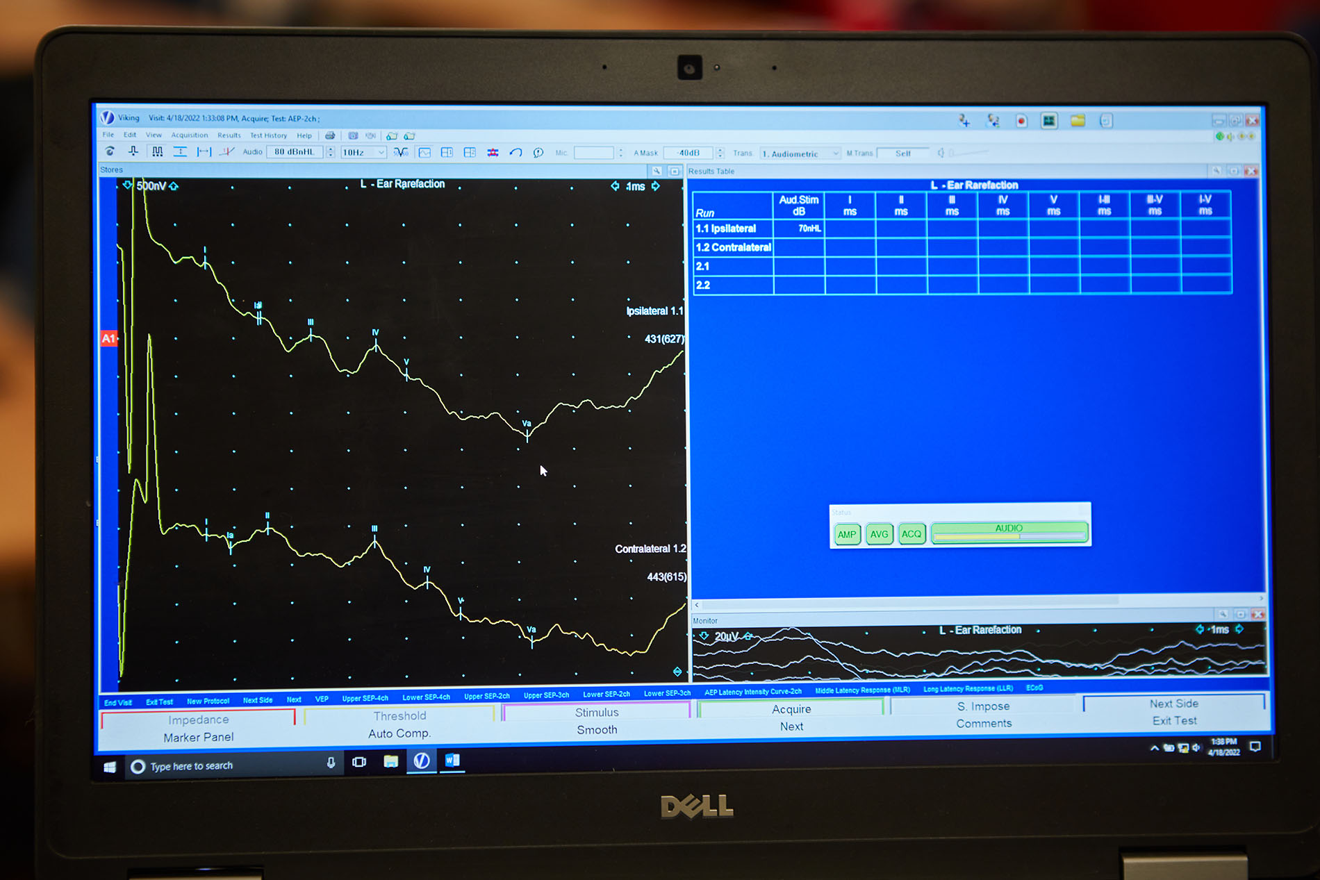 EEG graph on a computer screen